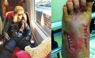 颈椎受伤的明星,颈椎受伤明星的康复之路